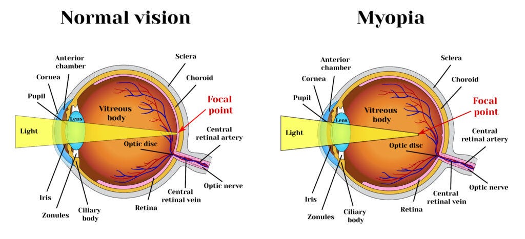 Myopia and Nearsightedness Control | Stahl EyeCare | Long Island NY Myopia and Nearsightedness Control | Stahl EyeCare | Long Island NY