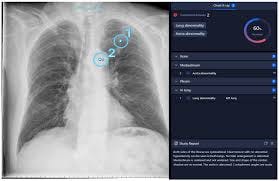Navigating the Spectrum: Assessing the Concordance of ML-Based AI Findings  with Radiology in Chest X-Rays in Clinical Settings