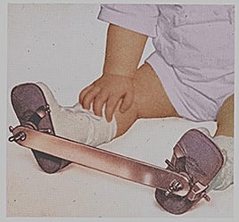 A colorized photo showing a baby’s legs wearing orthopedic braces. The braces consist of two white leather shoes connected by a metal bar at the soles, positioned to keep the feet apart for alignment.