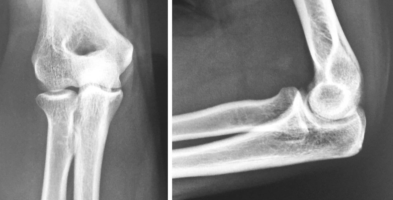 Case 25: A Painful Elbow
