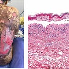 Stevens-Johnson Syndrome caused by Endotoxin in Jabs