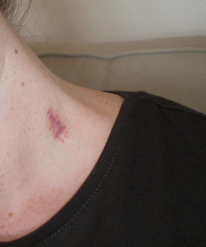 love bite hickey love bite hickey