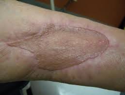 Case Study: Necrotizing Fasciitis ... Case Study: Necrotizing Fasciitis ...
