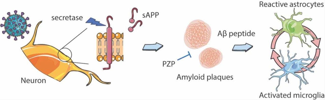 Verändertes Amyloid-Plasmaprofil bei Patienten mit behindernden Kopfschmerzen nach SARS-CoV-2-Infektion und Impfung 