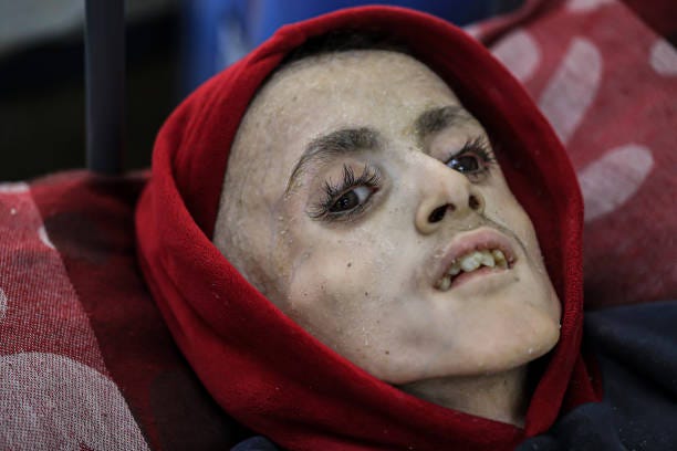 Yezen Al-Kfarna, a 10 year old Palestinian boy who suffers malnourishment due to the ongoing Israeli blockade receives medical treatment with limited...