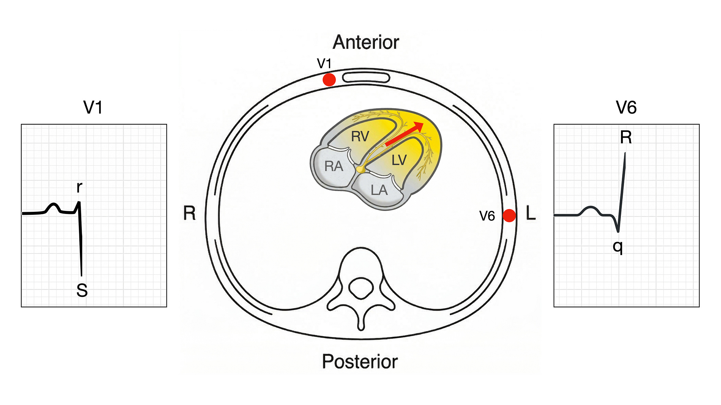 Phase 2 of normal ventricular depolarisation showing LV-dominant free wall activation with rS in V1 and qR in V6