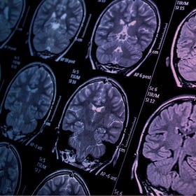 dear parents,here's how PANDAS impacts the basal ganglia
