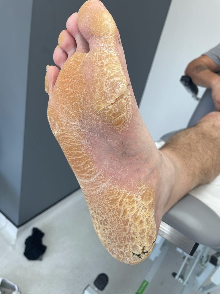 Callus - Hyperkeratosis - Manchester Feet