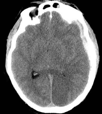 Posterior circulation infarction | Radiology Reference Article |  Radiopaedia.org
