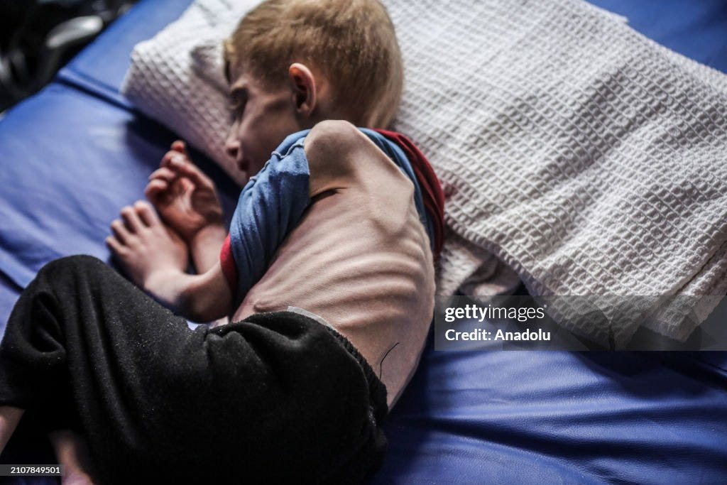 9-year-old Palestinian boy experiencing malnutrition evacuated from northern Gaza to IMC field hospital in Rafah