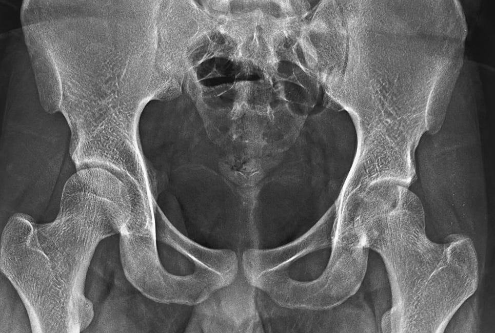 Case 72 - A Benign Aggressive Epiphyseal Lesion in the Left Femoral Head