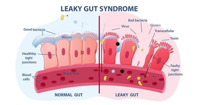 Leaky gut Syndrome. Comparison of healthy organ and inflamed tissue cells. Diseases of gastrointestinal tract. Moving banner with medical infographics. Flat graphic animated cartoon Leaky gut Syndrome. Comparison of healthy organ and inflamed tissue cells. Diseases of gastrointestinal tract. Moving banner with medical infographics. Flat graphic animated cartoon