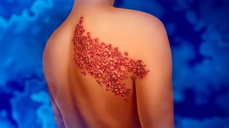 difference between herpes and shingles