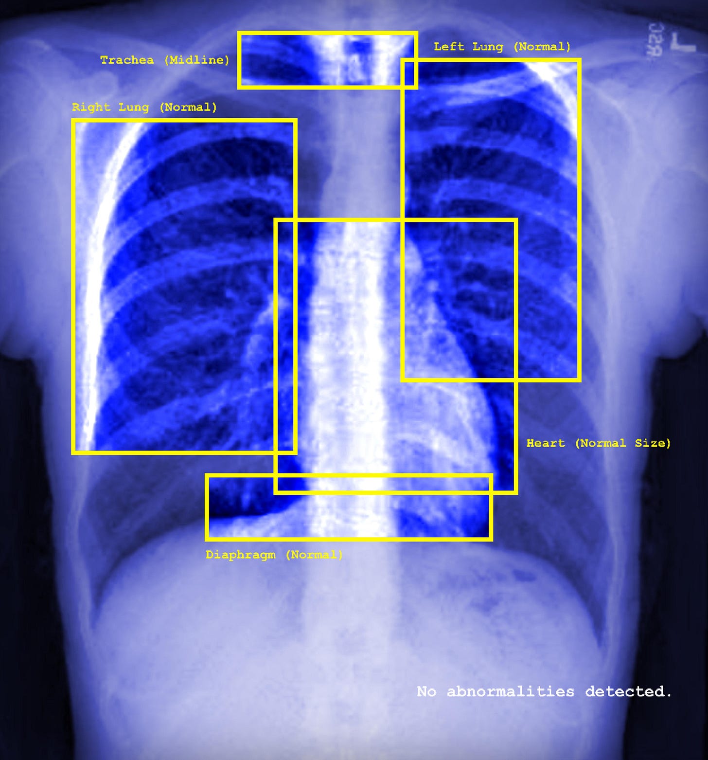 This image shows a blue xray image of a person's chest - it shows the ribs, the faint outline of a heart, and other organs. The image features yellow squares surrounding the organs (left lung, trachea, right lung, heart, diaphragm) - each of them feature labels such as: normal, midline, normal size. There is text in the right bottom corner in white which states 'no abnormalities detected'. This image shows a blue xray image of a person's chest - it shows the ribs, the faint outline of a heart, and other organs. The image features yellow squares surrounding the organs (left lung, trachea, right lung, heart, diaphragm) - each of them feature labels such as: normal, midline, normal size. There is text in the right bottom corner in white which states 'no abnormalities detected'.