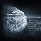 Brustkrebs-Screening: Mini-Nutzen ziemlich teuer erkauft – Transkript