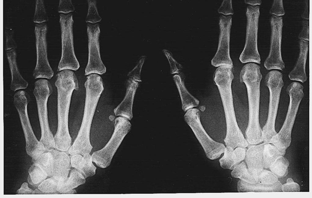 LABS for CHRONIC PAIN (5) What is the probable diagnosis and next lab test?