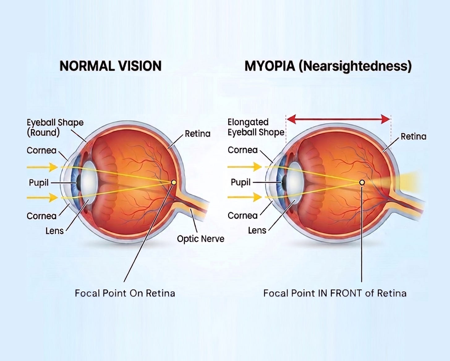 Why Myopia Matters | Treehouse Eyes Why Myopia Matters | Treehouse Eyes