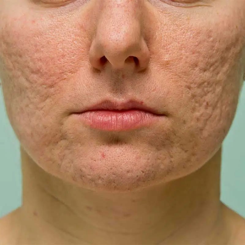 Textured Skin Treatments at Refresh MedSpa