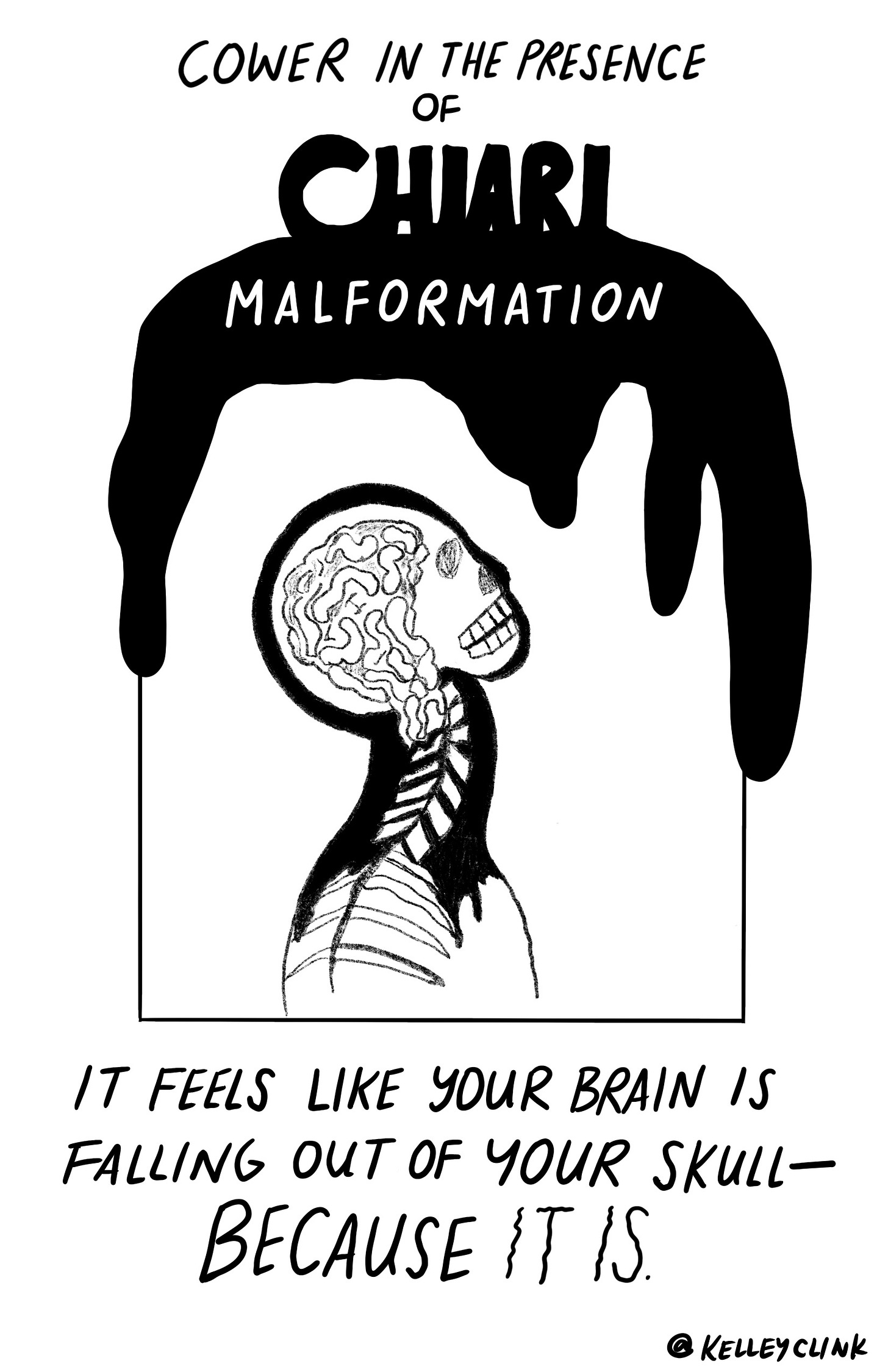 Cower in the presence of Chiari Malformation. Drawing of an X-ray of a human, their brain leaking into their spine. It feels like your brain is falling out of your skull—BECAUSE IT IS.
