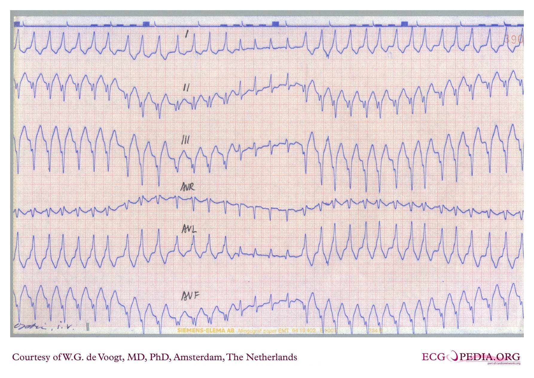 Limb-lead rhythm strip recording Limb-lead rhythm strip recording