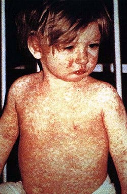 A close-up of a child with red rashes

AI-generated content may be incorrect.