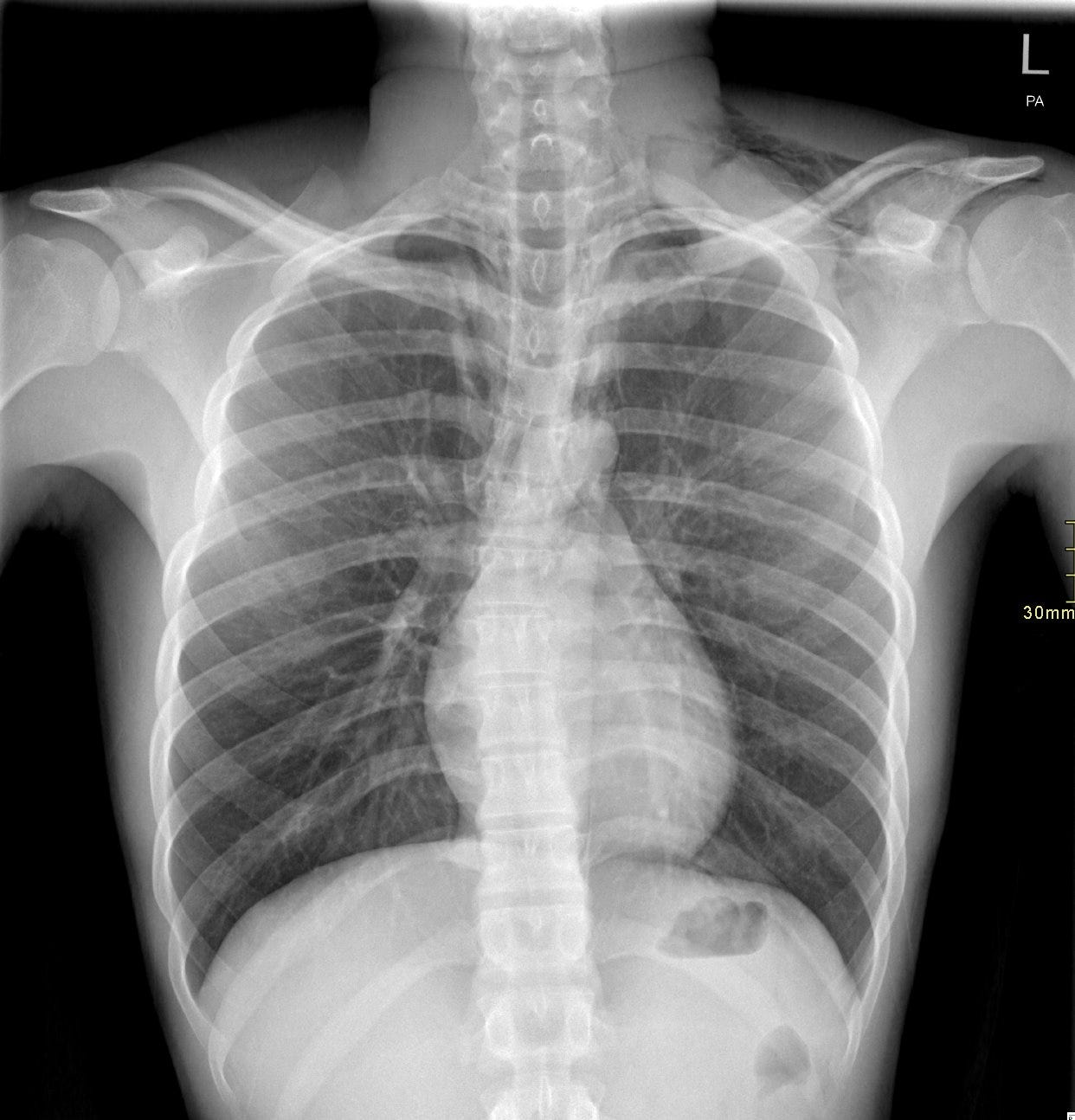 A x-ray of a person's chest
Description automatically generated