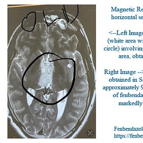 Case Report: Diffuse Midline Glioma, age 27, Male