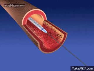ANGIOPLASTY STENT on Make a GIF