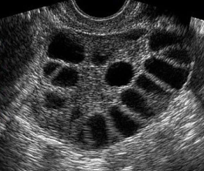 What Is PCOS? A Complete Guide to Polycystic Ovary Syndrome - EZRA Clinic