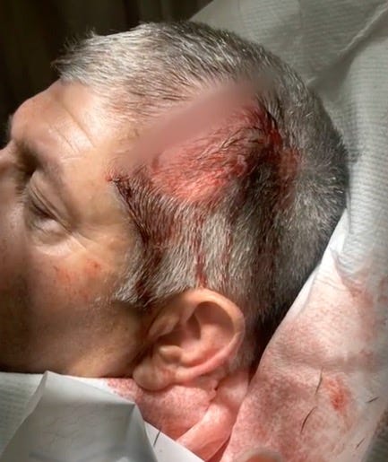 Man with a severe head wound with blood on his scalp and hair.