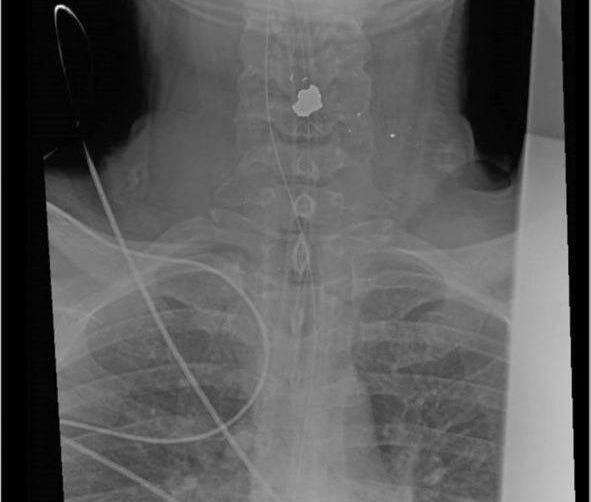 May be an image of bone and xray