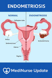 Endometriosis is a common, yet often underdiagnosed ...