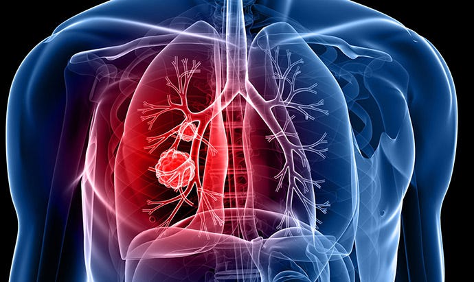 Who should be screened for lung cancer? | Cancer Council NSW