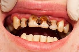 What Are Dental Cavities? Symptoms ...