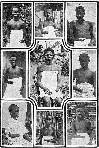 Mutilated children in the Congo Free State Mutilated children in the Congo Free State