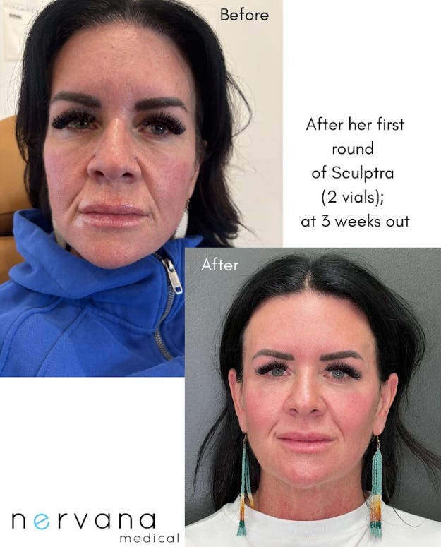 Restoring Facial Volume After Weight Loss: How Collagen-Bio-Stimulators and Hyaluronic Acid Fillers Can Help