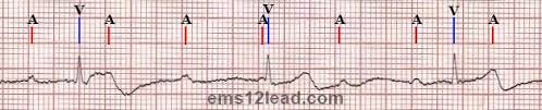 Second Degree or Third Degree Atrioventricular Block? | EMS 12 Lead