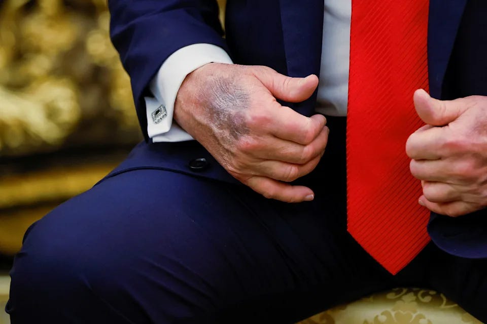 Trump's hand makeup, bruise go viral again. Here's what the White House has  said about it.