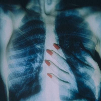 This may contain: an x - ray image of a woman's chest with her hands on the ribs