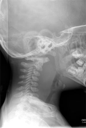 Retropharyngeal abscess plain radiograph - UpToDate