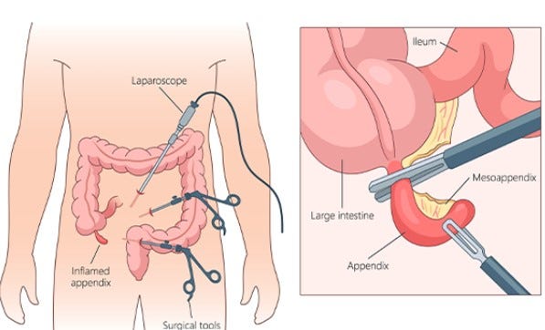 Jewish Invention Myths: The Appendectomy - Karl’s Substack