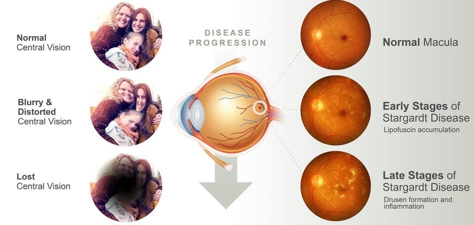 Stargardt Eye Disease Cure - Low Vision Aids