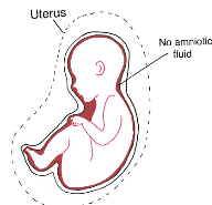 Early Pregnancy Renal Anhydramnios Early Pregnancy Renal Anhydramnios