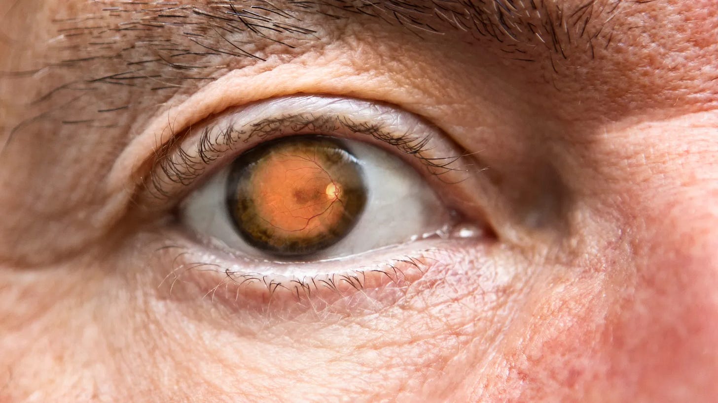 Tarsus Acquires Alkeus for Up to $800M, Expanding Rare Eye Disease Pipeline