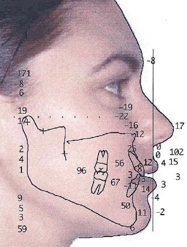 perfiloplastia, harmonização facial