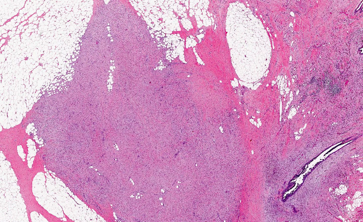 Fibromatosis-like metaplastic carcinoma Fibromatosis-like metaplastic carcinoma