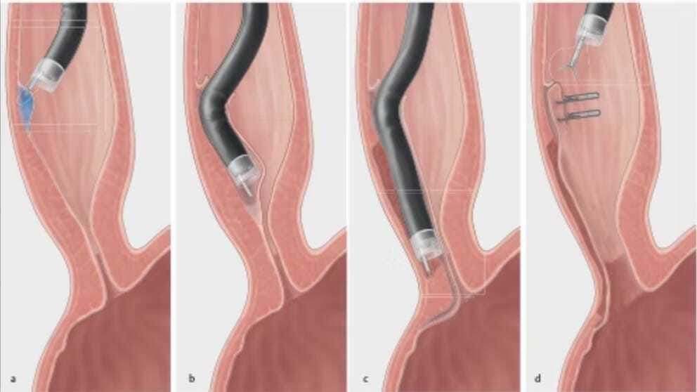 Ref.: 1. Inoue and Maydeo. Endoscopy 2019; 51: 1010–1012