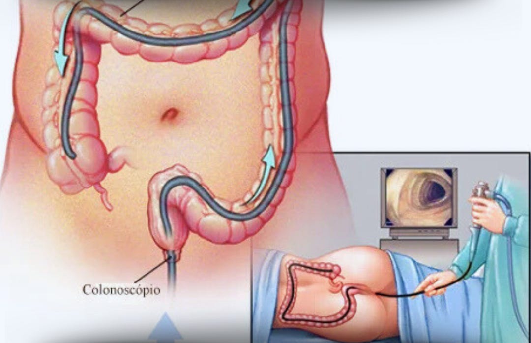 Como é feita a retirada dos pólipos intestinais