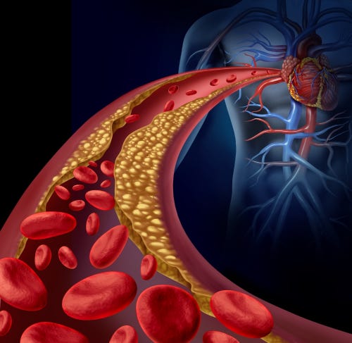 Cholesterol: How does it cause heart attacks and strokes? Preventive healthcare — CardioSound Cholesterol: How does it cause heart attacks and strokes? Preventive healthcare — CardioSound