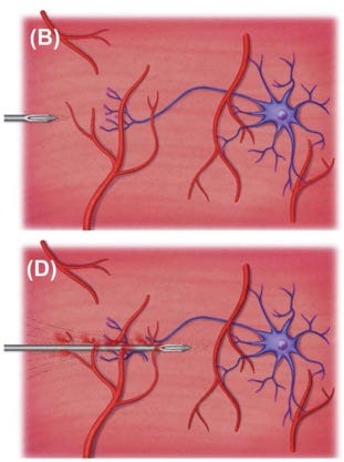 inserção da agulha